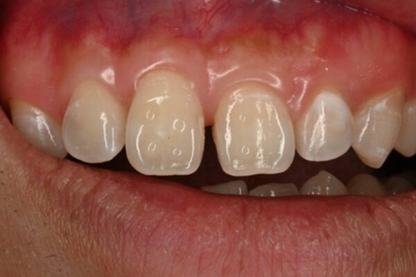 ビフォー画像|【症例】正中離開に対するダイレクトボンディング治療|自由が丘の歯医者 三好歯科 自由が丘