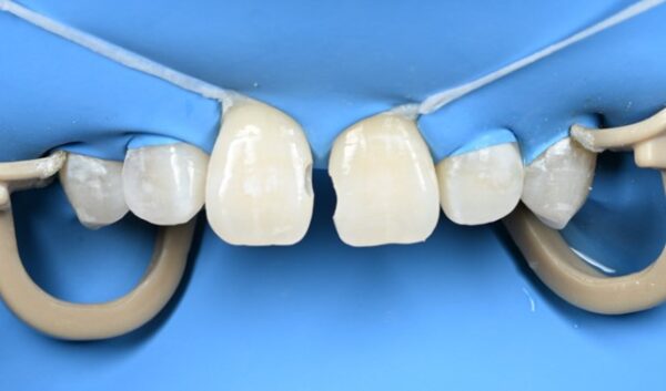 治療詳細①|【症例】正中離開に対するダイレクトボンディング治療|自由が丘の歯医者 三好歯科 自由が丘