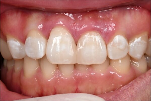 アフター画像|【症例】正中離開に対するダイレクトボンディング治療|自由が丘の歯医者 三好歯科 自由が丘