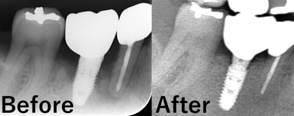【症例】他院で埋入されたインプラント周囲炎の再治療