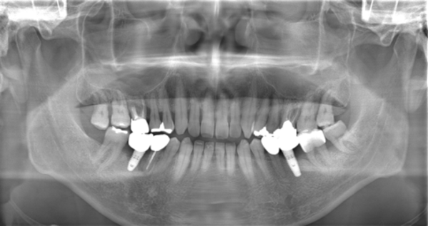 初診時パノラマX線写真|【症例】他院で埋入されたインプラント周囲炎の再治療|自由が丘の歯医者 三好歯科 自由が丘
