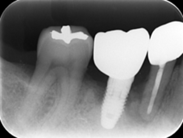 右下6番相当部のみのX線写真|【症例】他院で埋入されたインプラント周囲炎の再治療|自由が丘の歯医者 三好歯科 自由が丘