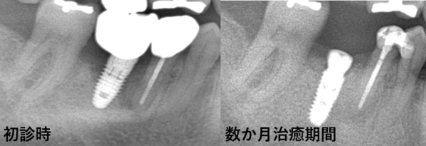 術前後part2|【症例】他院で埋入されたインプラント周囲炎の再治療|自由が丘の歯医者 三好歯科 自由が丘