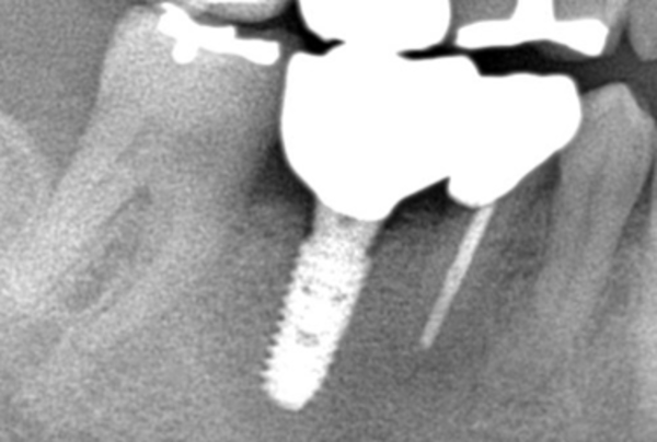完成版|【症例】他院で埋入されたインプラント周囲炎の再治療|自由が丘の歯医者 三好歯科 自由が丘