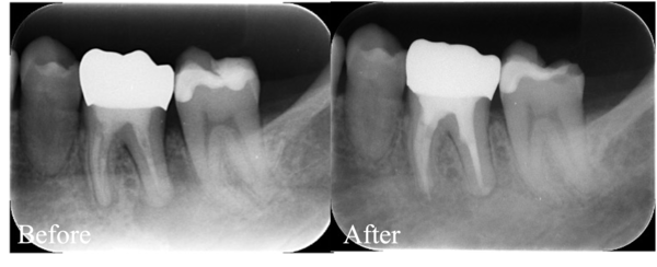 【症例】根管治療の成功率を下げる「落とし穴」