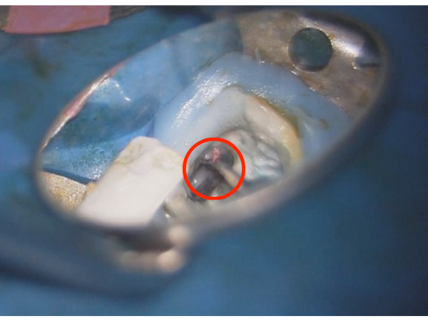 根管充填材を除去｜【症例】根管治療の成功率を下げる「落とし穴」| 自由が丘の歯医者 三好歯科 自由が丘