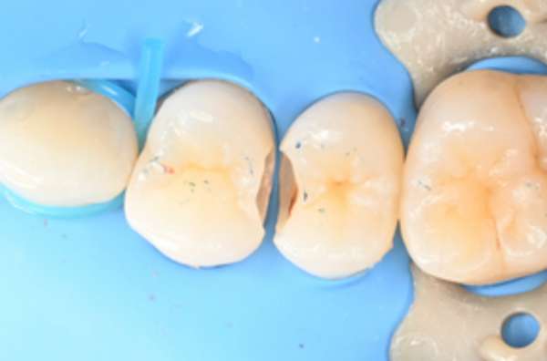残りの虫歯除去│【症例】精密な接着技術で歯を守るダイレクトボンディング修復｜ 自由が丘の歯医者 三好歯科 自由が丘